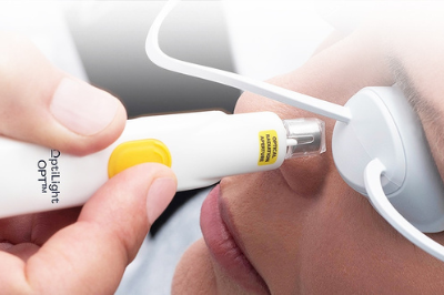 Optilight IPL treatment
